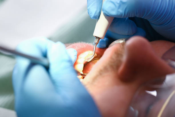 Best Emergency Tooth Extraction in Yoe, PA